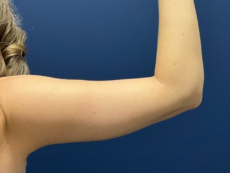 Brachioplasty by Dr. Booth Before & After Gallery - Patient 184931 - Image 2