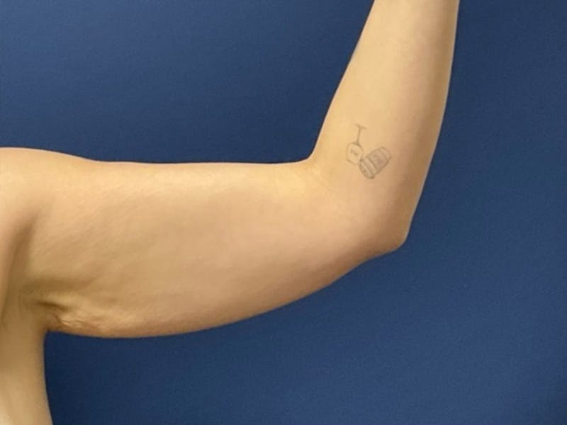 Brachioplasty by Dr. Booth Before & After Gallery - Patient 184931 - Image 3