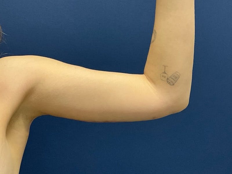 Brachioplasty by Dr. Booth Before & After Gallery - Patient 184931 - Image 4
