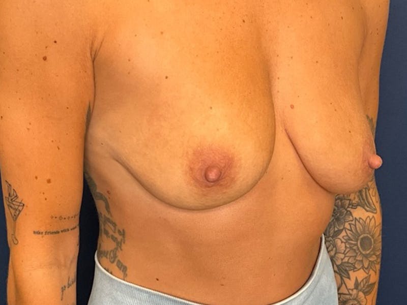 Breast Lift by Dr. Booth Before & After Gallery - Patient 333088 - Image 5