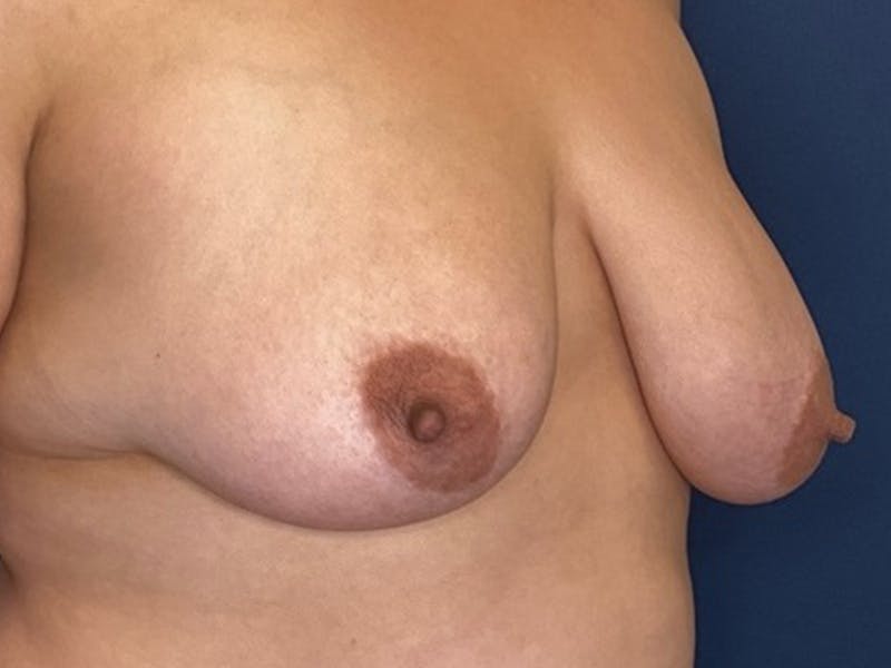 Breast Lift by Dr. Booth Before & After Gallery - Patient 317679 - Image 5