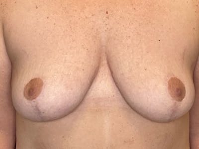 Breast Lift by Dr. Booth Before & After Gallery - Patient 192738 - Image 2