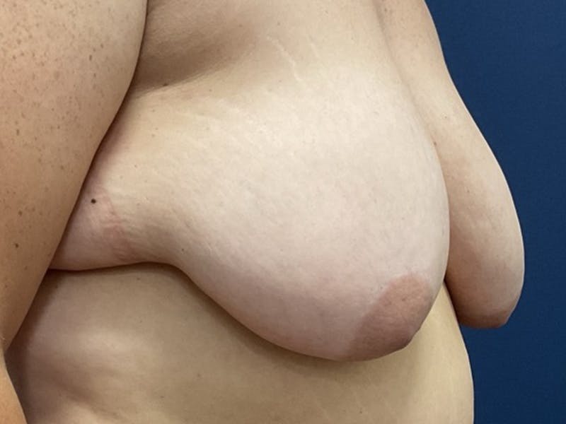 Breast Lift by Dr. Booth Before & After Gallery - Patient 192738 - Image 5