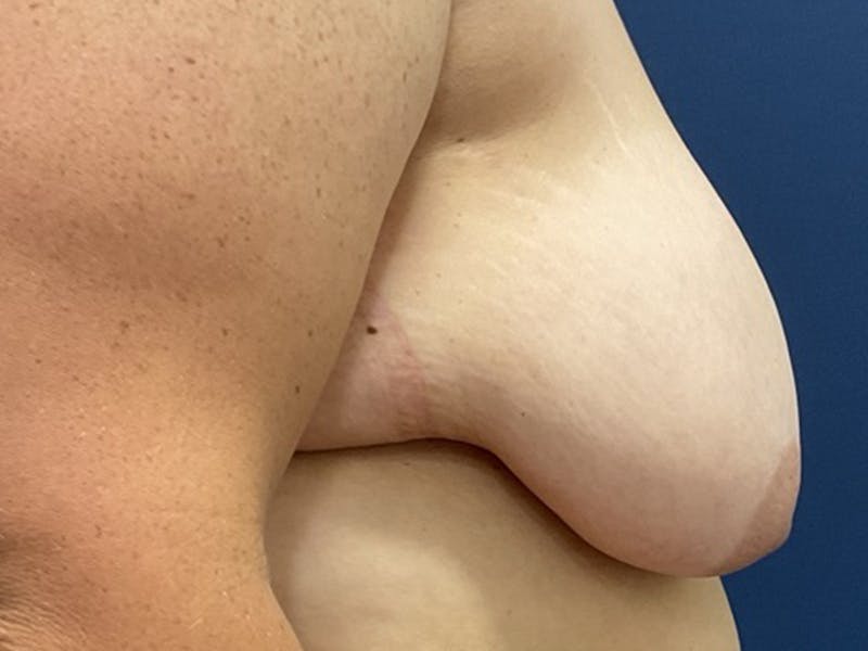 Breast Lift by Dr. Booth Before & After Gallery - Patient 192738 - Image 7