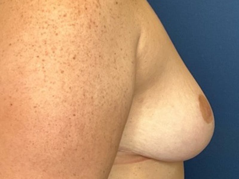 Breast Lift by Dr. Booth Before & After Gallery - Patient 192738 - Image 8