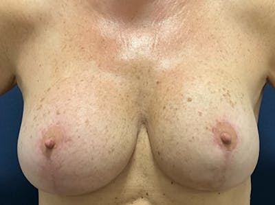 Breast Revision by Dr. Booth Before & After Gallery - Patient 407040 - Image 2