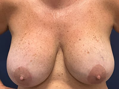 Breast Revision by Dr. Booth Before & After Gallery - Patient 407040 - Image 1
