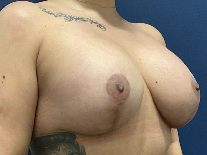 Breast Revision by Dr. Booth Before & After Gallery - Patient 276412 - Image 4