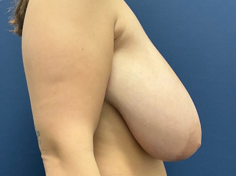 Breast Reduction by Dr. Booth Before & After Gallery - Patient 278388 - Image 5