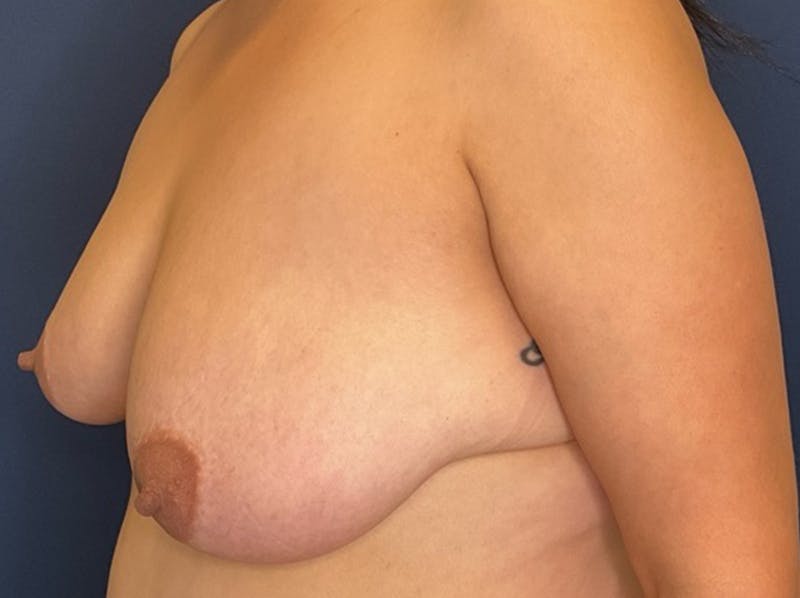 Breast Reduction by Dr. Booth Before & After Gallery - Patient 893069 - Image 3