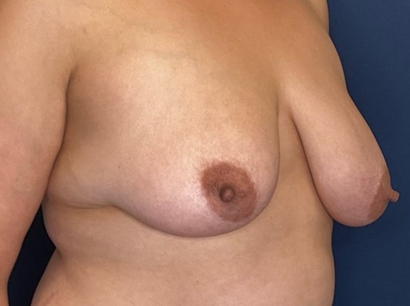 Breast Reduction by Dr. Booth Before & After Gallery - Patient 893069 - Image 5