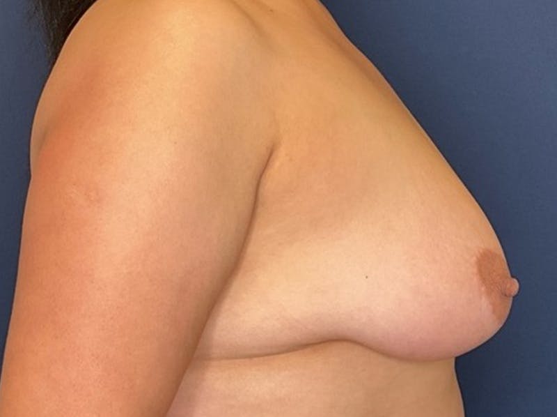 Breast Reduction by Dr. Booth Before & After Gallery - Patient 893069 - Image 7