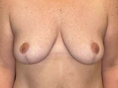 Breast Reduction by Dr. Booth Before & After Gallery - Patient 266832 - Image 2
