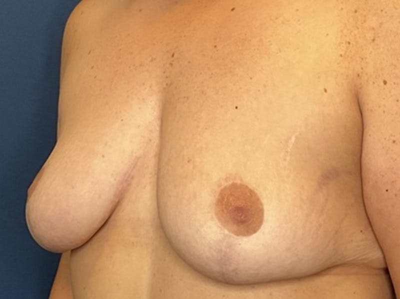 Breast Reduction by Dr. Booth Before & After Gallery - Patient 266832 - Image 4