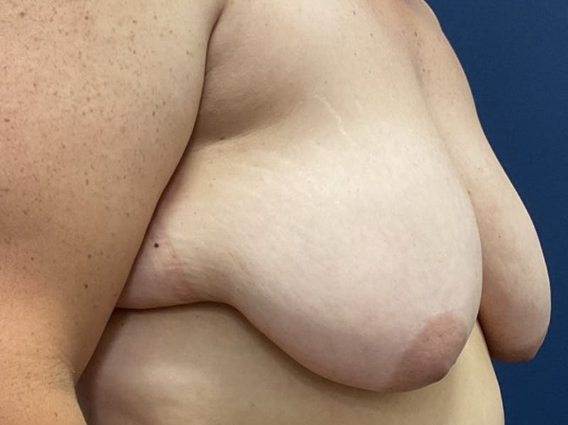 Breast Reduction by Dr. Booth Before & After Gallery - Patient 266832 - Image 5