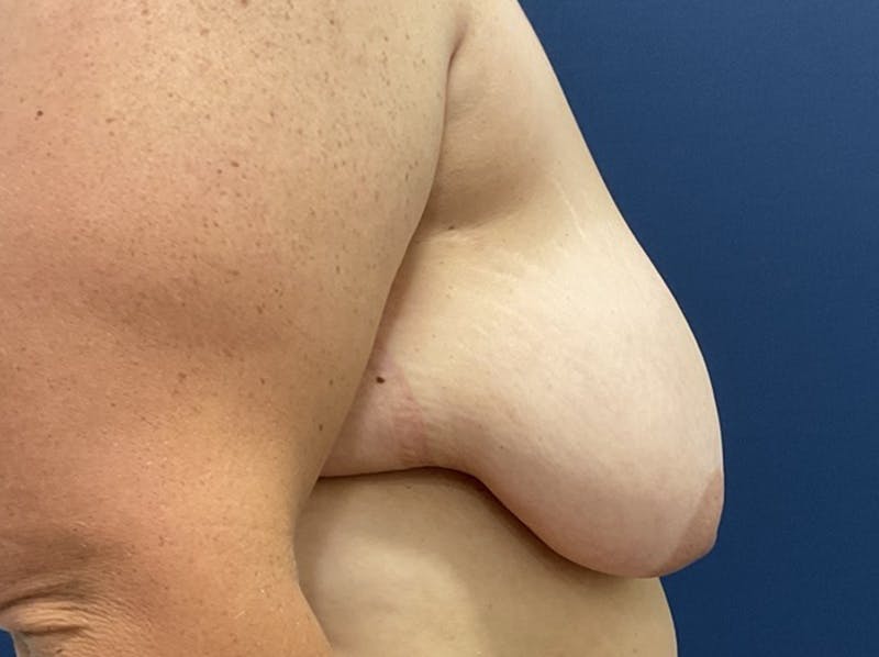 Breast Reduction by Dr. Booth Before & After Gallery - Patient 266832 - Image 7