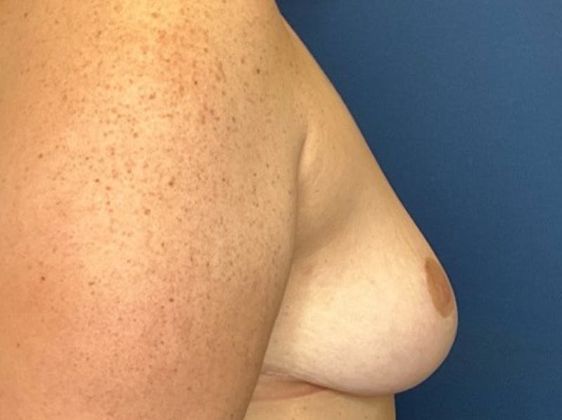 Breast Reduction by Dr. Booth Before & After Gallery - Patient 266832 - Image 8