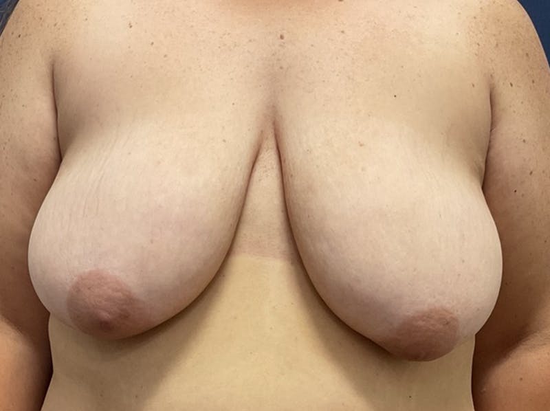 Breast Reduction by Dr. Booth Before & After Gallery - Patient 266832 - Image 1