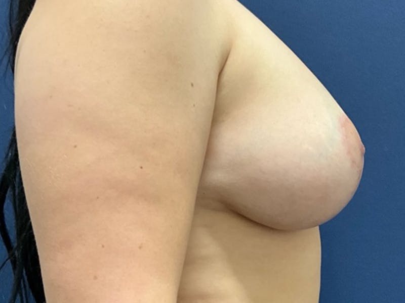  Breast Lift with Implant Exchange Dr. Booth Before & After Gallery - Patient 184280 - Image 7
