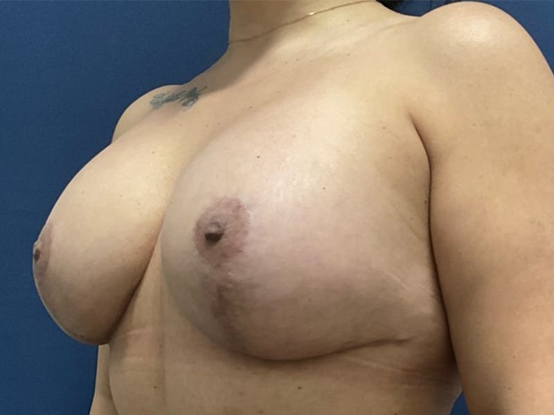  Breast Lift with Implant Exchange Dr. Booth Before & After Gallery - Patient 414565 - Image 4