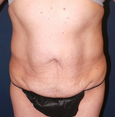 Liposuction by Dr. Booth Before & After Gallery - Patient 346816 - Image 1
