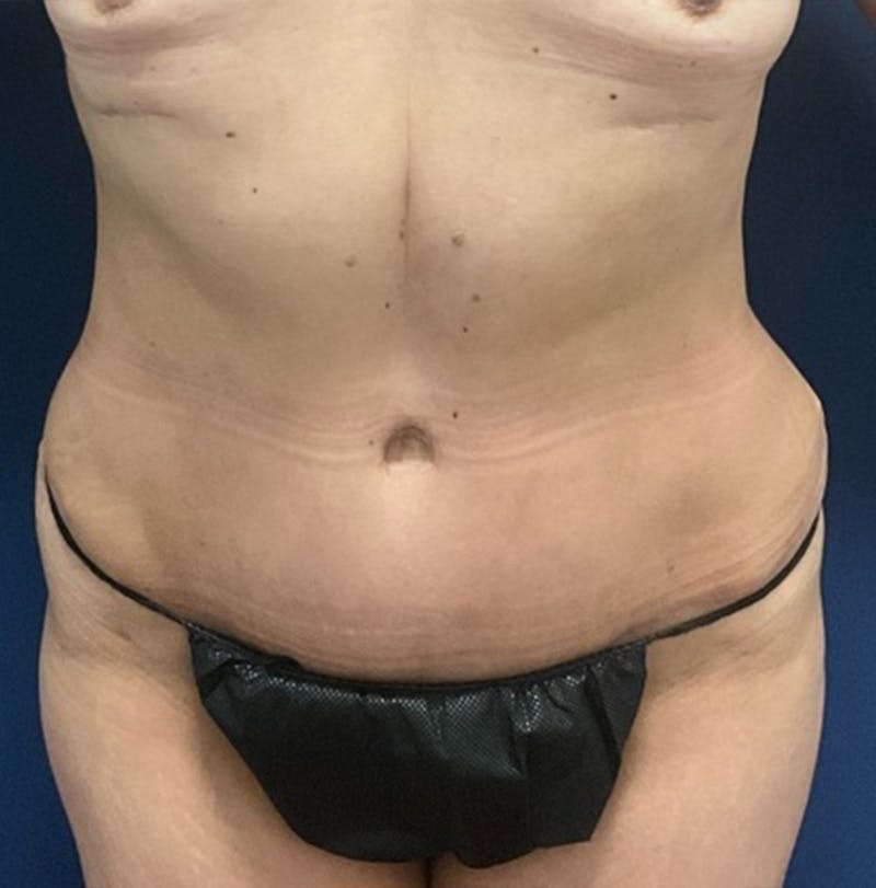 Liposuction by Dr. Booth Before & After Gallery - Patient 346816 - Image 2