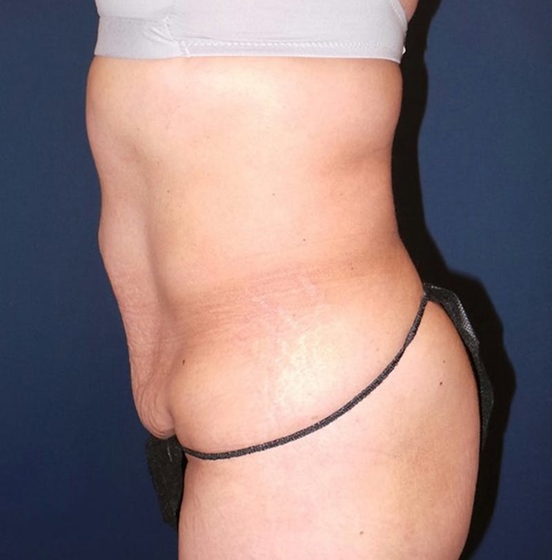 Liposuction by Dr. Booth Before & After Gallery - Patient 346816 - Image 5