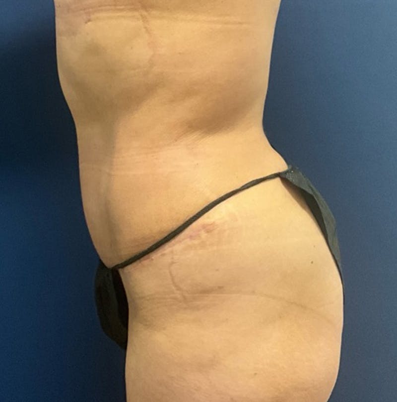 Liposuction by Dr. Booth Before & After Gallery - Patient 346816 - Image 6