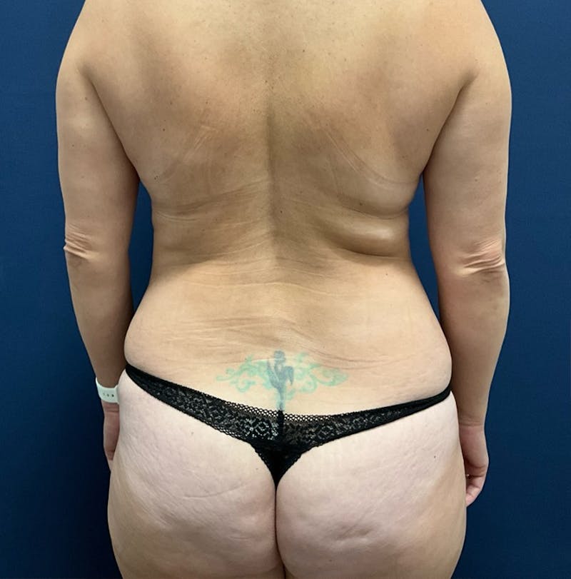 Liposuction by Dr. Booth Before & After Gallery - Patient 279629 - Image 5