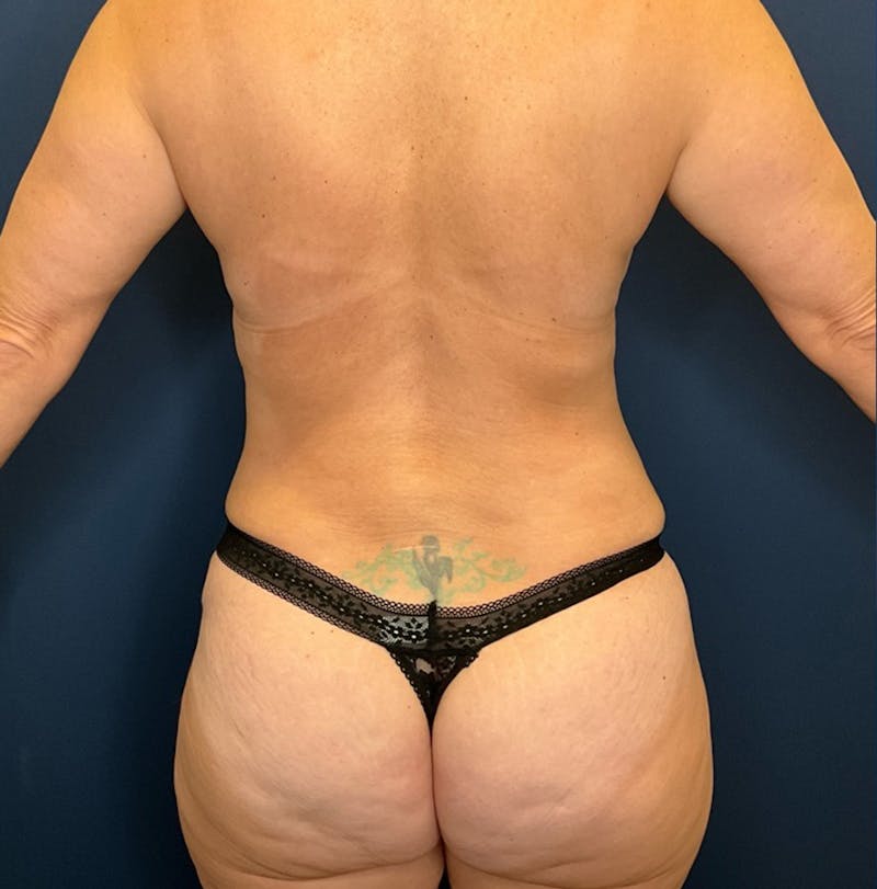 Liposuction by Dr. Booth Before & After Gallery - Patient 279629 - Image 6