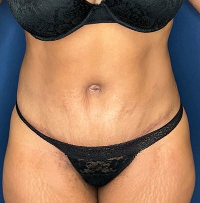 Liposuction by Dr. Booth Before & After Gallery - Patient 382380 - Image 2