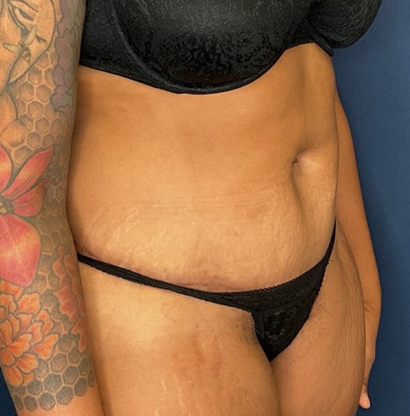 Liposuction by Dr. Booth Before & After Gallery - Patient 382380 - Image 4