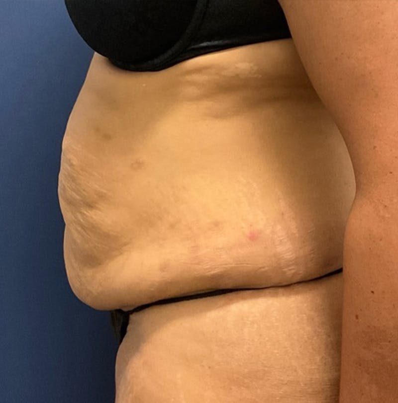 Liposuction by Dr. Booth Before & After Gallery - Patient 382380 - Image 5