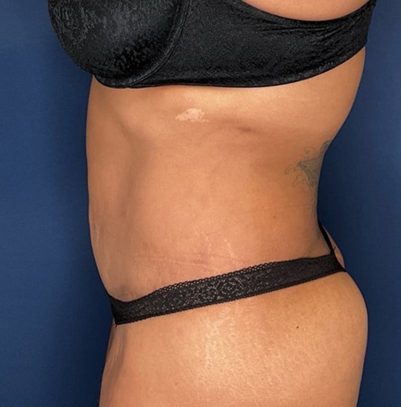 Liposuction by Dr. Booth Before & After Gallery - Patient 382380 - Image 6