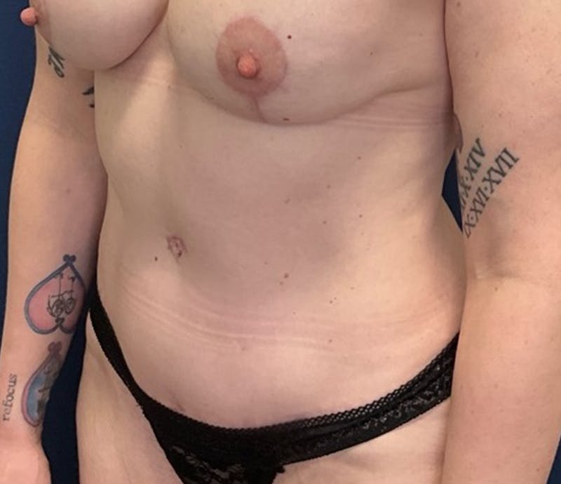 Liposuction by Dr. Booth Before & After Gallery - Patient 221440 - Image 4