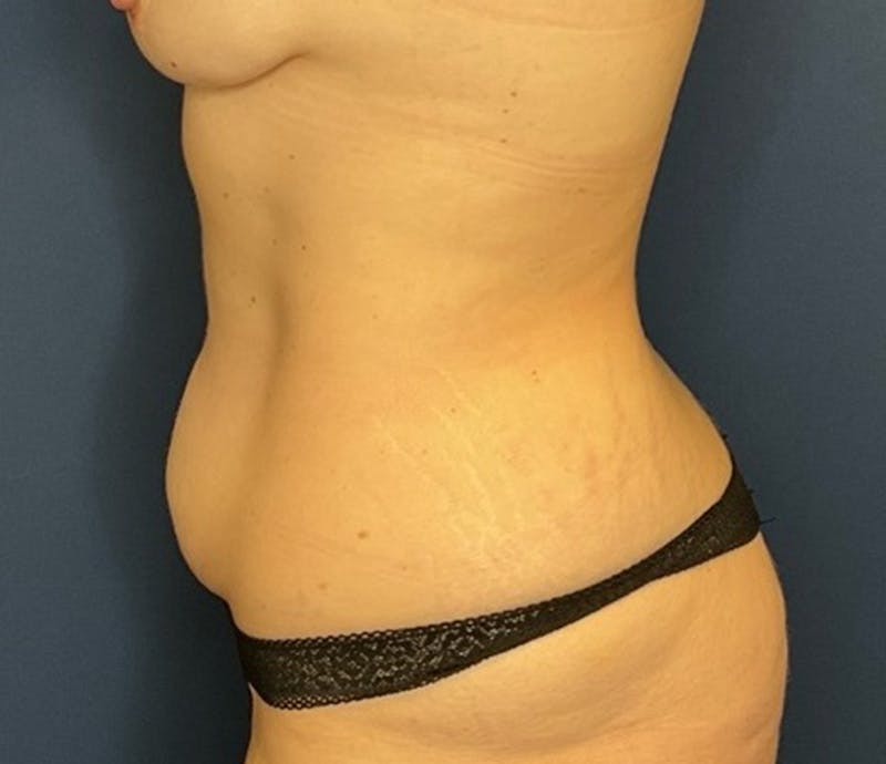Liposuction by Dr. Booth Before & After Gallery - Patient 221440 - Image 5