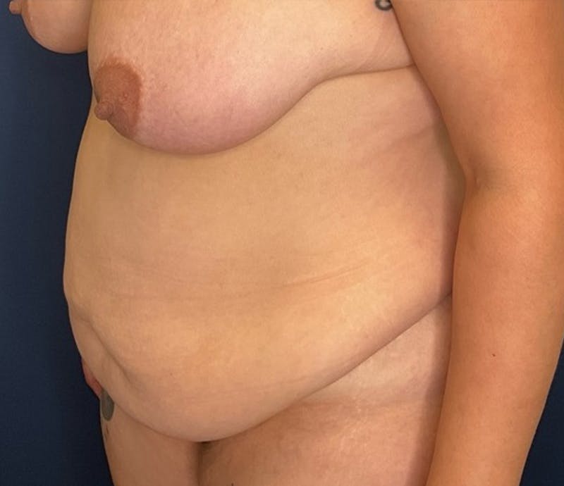 Lipo 360 by Dr. Booth Before & After Gallery - Patient 368797 - Image 7