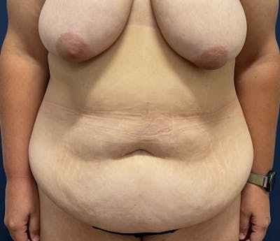 Liposuction by Dr. Booth Before & After Gallery - Patient 299243 - Image 1