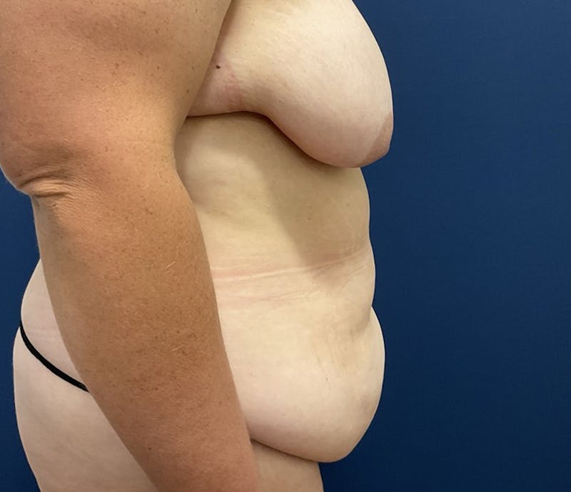 Lipo 360 by Dr. Booth Before & After Gallery - Patient 342746 - Image 7
