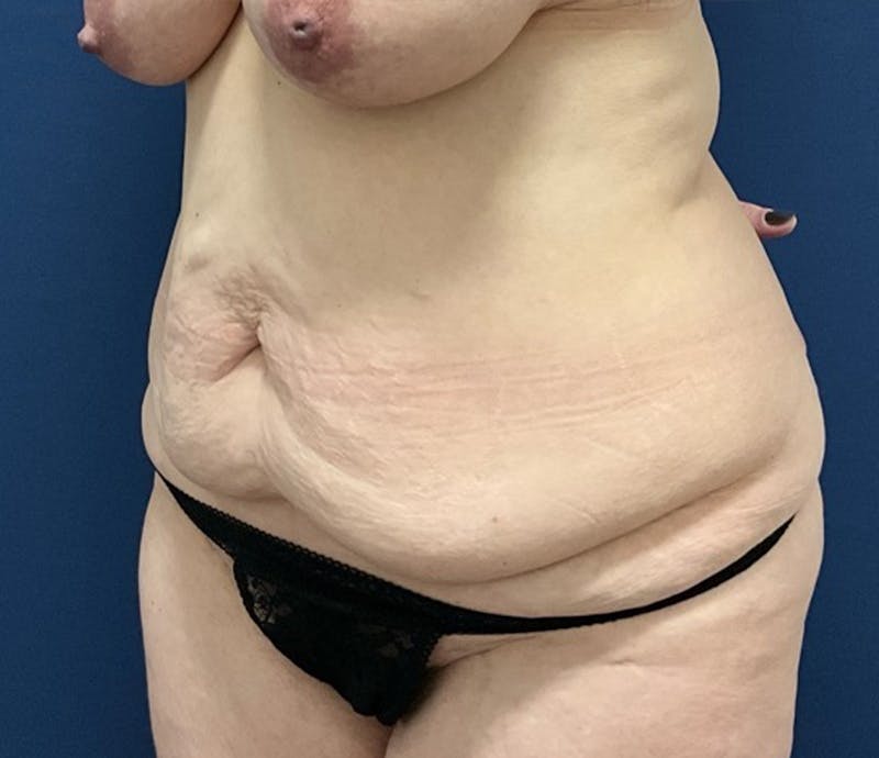 BodyTite by Dr. Booth Before & After Gallery - Patient 264538 - Image 5