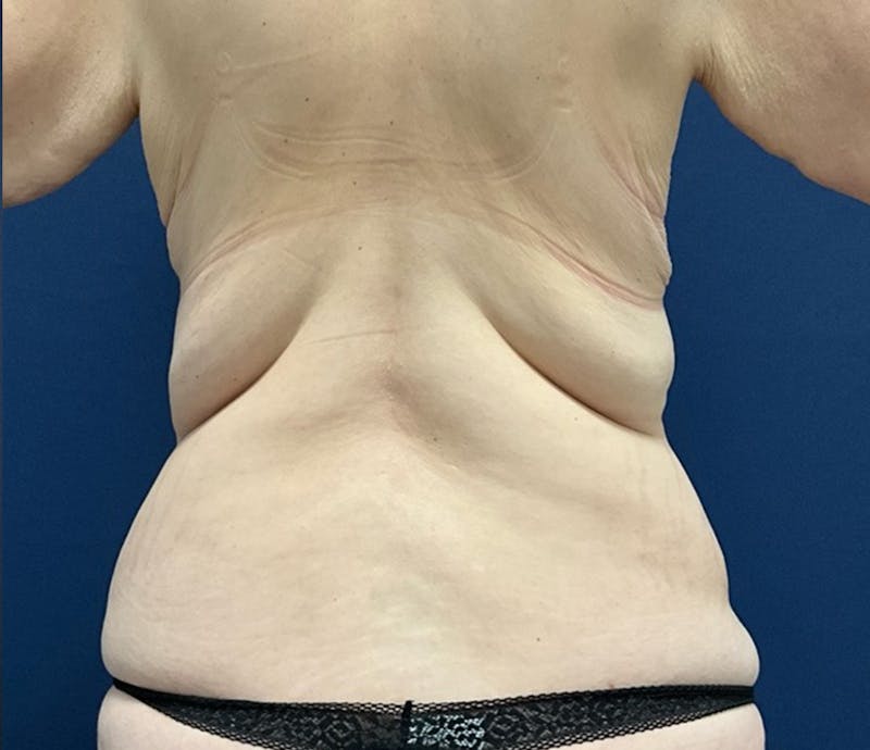 BodyTite by Dr. Booth Before & After Gallery - Patient 264538 - Image 9