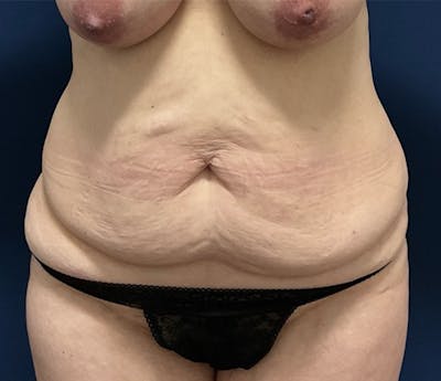BodyTite by Dr. Booth Before & After Gallery - Patient 264538 - Image 1