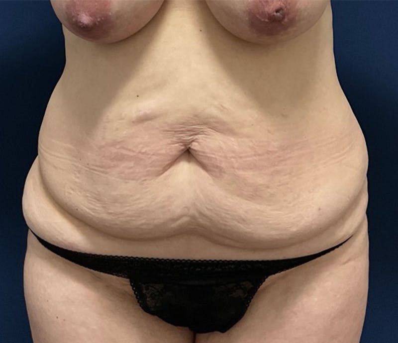 BodyTite by Dr. Booth Before & After Gallery - Patient 264538 - Image 1