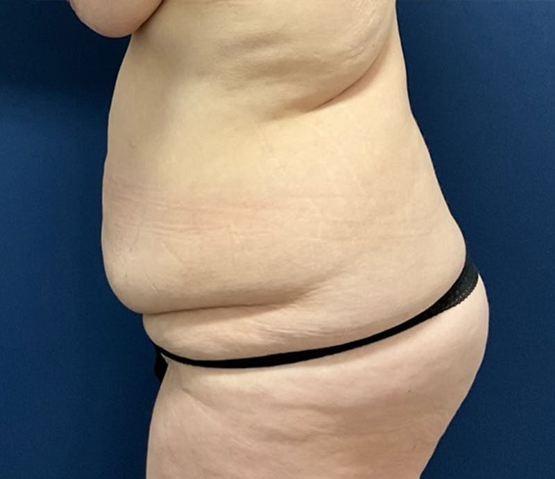 BodyTite by Dr. Booth Before & After Gallery - Patient 264538 - Image 7