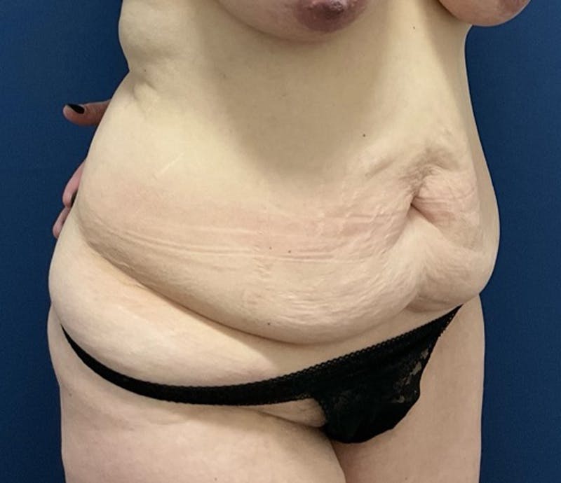 BodyTite by Dr. Booth Before & After Gallery - Patient 264538 - Image 3