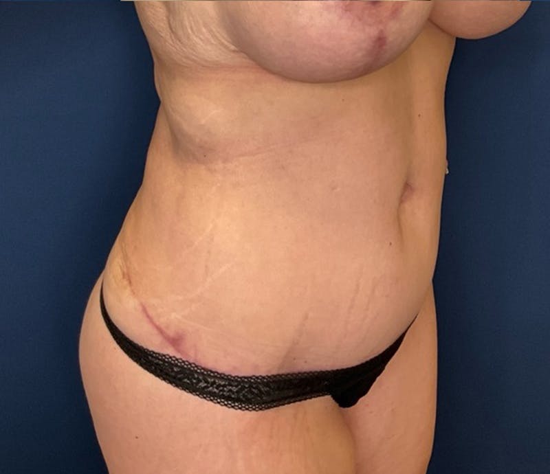 BodyTite by Dr. Booth Before & After Gallery - Patient 264538 - Image 4