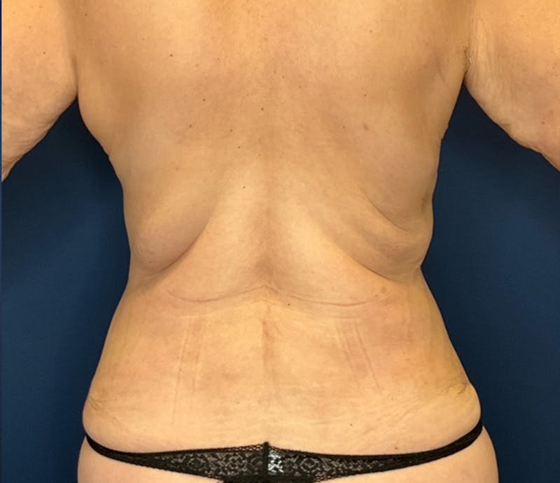 BodyTite by Dr. Booth Before & After Gallery - Patient 264538 - Image 10