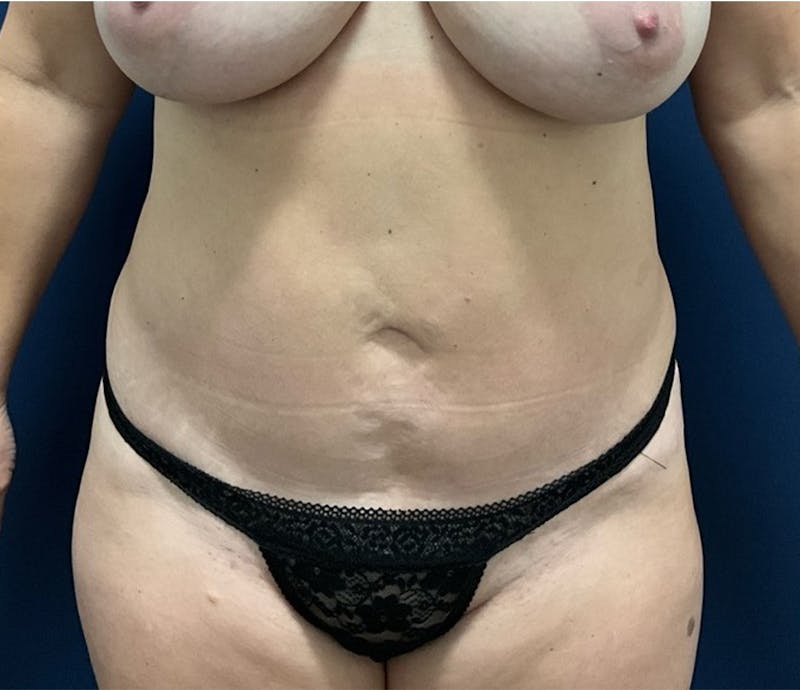 BodyTite by Dr. Booth Before & After Gallery - Patient 129886 - Image 1