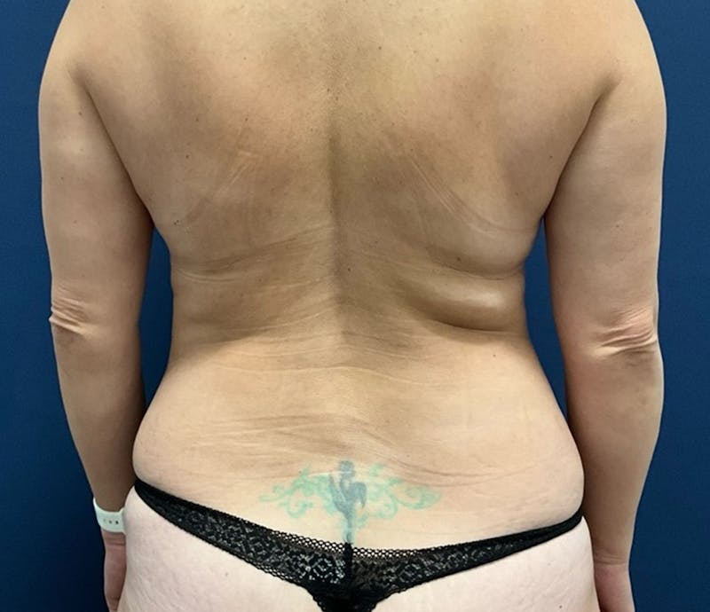 BodyTite by Dr. Booth Before & After Gallery - Patient 129886 - Image 5