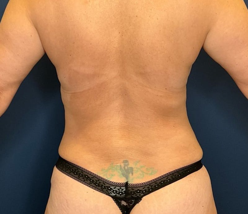 BodyTite by Dr. Booth Before & After Gallery - Patient 129886 - Image 6